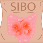 Treating SIBO as the Root Cause of Irritable Bowel Syndrome (IBS) – Part 2